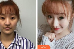 上饒尚美醫(yī)療美容門診部張維華整形價格表附眼部綜合案例展示