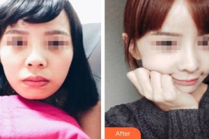 上饒尚美醫(yī)療美容門診部王先成整形價格表附鼻部綜合案例展示