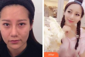 上饒尚美醫(yī)療美容門診部余婷整形價格表附埋線提升案例展示