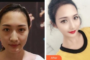 上饒德爾美客醫(yī)療美容門診部程梓寧整形價格表附射頻緊膚案例展示