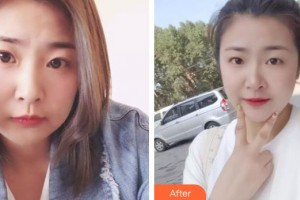 上饒協(xié)和醫(yī)院整形美容科王雙余整形價格表附熱拉提案例展示