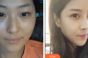 上饒雙博星范醫(yī)療美容門診部黃林波整形價格表附埋線提升案例展示