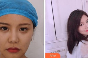 上饒愛爾眼科醫(yī)院吳定勇整形價格表附熱拉提案例展示