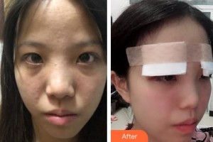 上饒愛爾眼科醫(yī)院羅建華整形價格表附眼部綜合案例展示