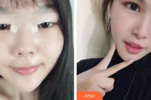 上饒愛爾眼科醫(yī)院蔣道源整形價格表附切開雙眼皮案例展示