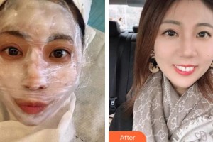 上饒愛爾眼科醫(yī)院錢進整形價格表附眼部綜合案例展示