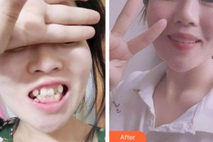 上饒維樂陽光口腔門診部徐奐整形價格表附金屬托槽矯正案例展示