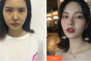 平頂山藝美醫(yī)療美容醫(yī)院白勝萬整形價格表附鼻部綜合案例展示