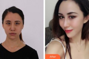 平頂山藝美醫(yī)療美容醫(yī)院楊曉順整形價格表附鼻部綜合案例展示