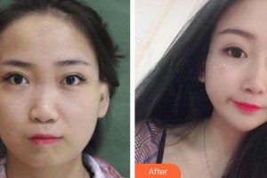 平頂山藝美醫(yī)療美容醫(yī)院王占良整形價格表附鼻部綜合案例展示