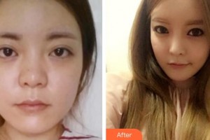 平頂山藝美醫(yī)療美容醫(yī)院王慧整形價格表附假體隆鼻案例展示