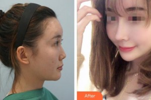 平頂山藝美醫(yī)療美容醫(yī)院于亮整形價格表附肋軟骨隆鼻案例展示