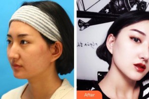 平頂山藝美醫(yī)療美容醫(yī)院孫召琪整形價格表附鼻骨矯正案例展示