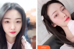 平頂山惟美整形醫(yī)院于偉超整形價格表附鼻部綜合案例展示