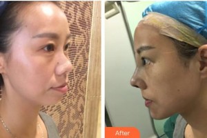 平頂山友誼整形醫(yī)院崔麗整形價格表附鼻部綜合案例展示