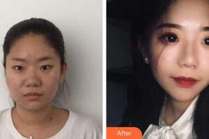 平頂山滕曉醫(yī)療整形醫(yī)院魏毓龍整形價格表附鼻部綜合案例展示