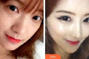 平頂山藝美醫(yī)療美容醫(yī)院潘圣戰(zhàn)整形價格表附鼻部綜合案例展示