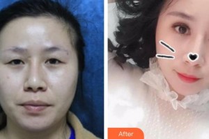 烏魯木齊市友誼醫(yī)院整形科宋路整形價格表附切開雙眼皮案例展示