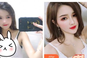 烏魯木齊王姣醫(yī)療美容診所王蛟整形價格表附耳軟骨復合隆鼻案例展示