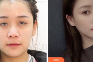 烏魯木齊美容學會整形美容門診部許黎整形價格表附鼻部綜合案例展示