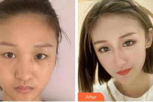 烏魯木齊普瑞眼科醫(yī)院胡裕坤整形價格表附眼部綜合案例展示