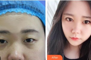 烏魯木齊伊麗莎白整形美容醫(yī)院楊春梅整形價格表附定點雙眼皮案例展示