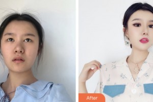 昆山博愛(ài)醫(yī)院整形美容中心林華整形價(jià)格表附眼部綜合案例展示