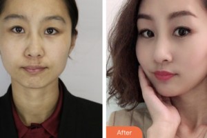 昆山百達(dá)麗醫(yī)療美容門診部薛麗華整形價(jià)格表附去痘印痘坑案例展示