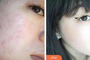 昆山百達(dá)麗醫(yī)療美容門診部馬志丹整形價(jià)格表附去痘印痘坑案例展示