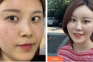 昆山鉑特麗醫(yī)療美容門診部金起憲整形價(jià)格表附激光祛斑案例展示