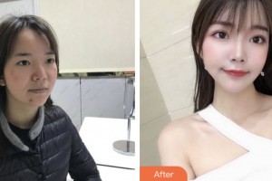 昆山鉑特麗醫(yī)療美容門診部李云鳳整形價(jià)格表附紅藍(lán)光祛痘案例展示