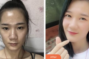 昆山鉑特麗醫(yī)療美容門診部閔熙埈整形價(jià)格表附微針?biāo)獍咐故?>
</a>
<h3 class=