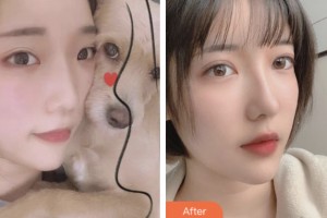 昆山魅萊醫(yī)療美容門診部金志揚(yáng)整形價(jià)格表附切開(kāi)雙眼皮案例展示