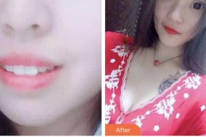 昆山萌牙客口腔門診部張飛飛整形價格表附牙齒隱形矯正案例展示