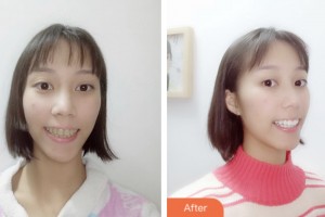 昆山愛爾眼科醫(yī)院周世芳整形價格表附口腔美白牙齒案例展示