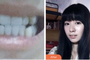 昆山同濟口腔醫(yī)院胡宏娥整形價格表附金屬托槽矯正案例展示