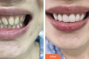 昆山同濟口腔醫(yī)院劉努整形價格表附牙貼面案例展示