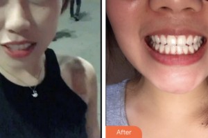 昆山同濟口腔醫(yī)院田連松整形價格表附超聲波潔牙案例展示