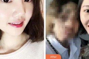 昆山禾豐口腔醫(yī)院張明進整形價格表附牙齒隱形矯正案例展示