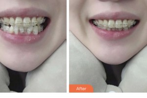 昆山益達口腔門診部浦海亞整形價格表附美白貼片案例展示