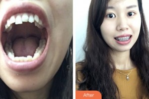 昆山益達口腔門診部徐恒整形價格表附金屬托槽矯正案例展示