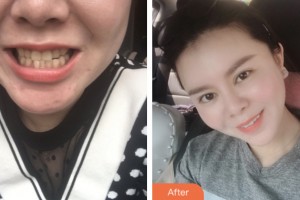 昆山益達口腔門診部黃向東整形價格表附牙齒隱形矯正案例展示