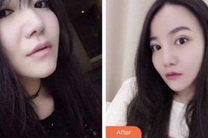 昆山益達口腔門診部朱肖蒙整形價格表附牙齒隱形矯正案例展示