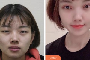 齊齊哈爾醫(yī)學院附屬第三醫(yī)院醫(yī)療美容科李云峰整形價格表附切開雙眼皮案例展示