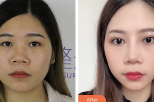 齊齊哈爾千百度整形美容醫(yī)院蔡里整形價(jià)格表附切開雙眼皮案例展示