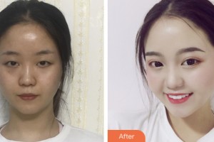 齊齊哈爾君悅醫(yī)療美容醫(yī)院吳淑華整形價(jià)格表附眼部綜合案例展示