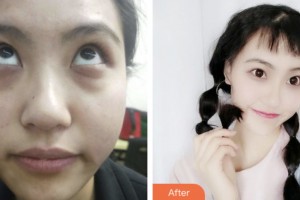 鹽城艾美莉整形美容醫(yī)院武金山整形價(jià)格表附內(nèi)切祛眼袋案例展示