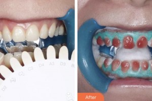 鹽城艾美莉整形美容醫(yī)院裔偉績(jī)整形價(jià)格表附美白劑美白牙齒案例展示