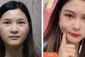 鹽城曙光愛(ài)爾眼科醫(yī)院程娟整形價(jià)格表附內(nèi)切祛眼袋案例展示