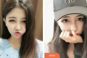 鹽城口腔醫(yī)院許海軍整形價(jià)格表附牙齒隱形矯正案例展示